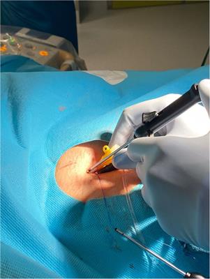 Same-day discharge after percutaneous closure of persistent foramen ovale using intracardiac echocardiography and the Gore Septal Occluder